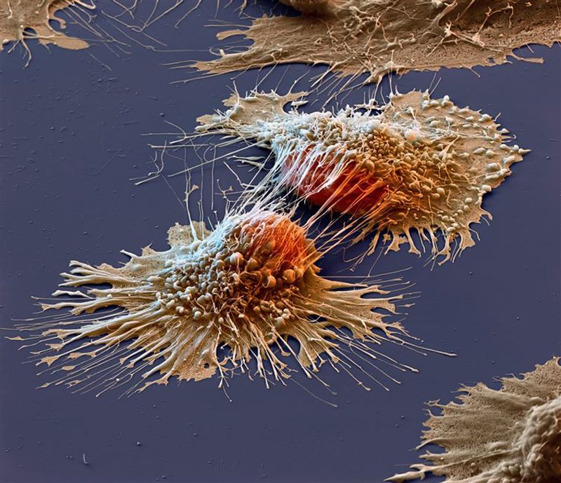 Cancer cells under an electron microscope
