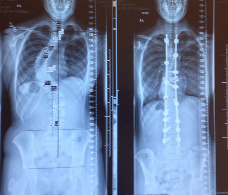 X-rays before and after treatment for scoliosis